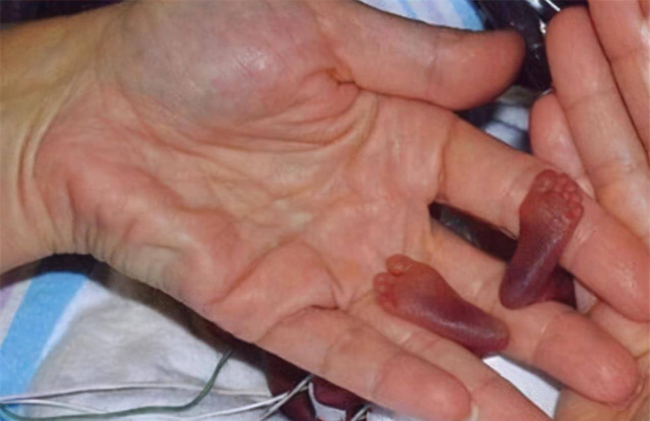 婴儿哭声翻译苹果版
:2002年，国外1名“拇指姑娘”出生，仅重280克，如今长得亭亭玉立